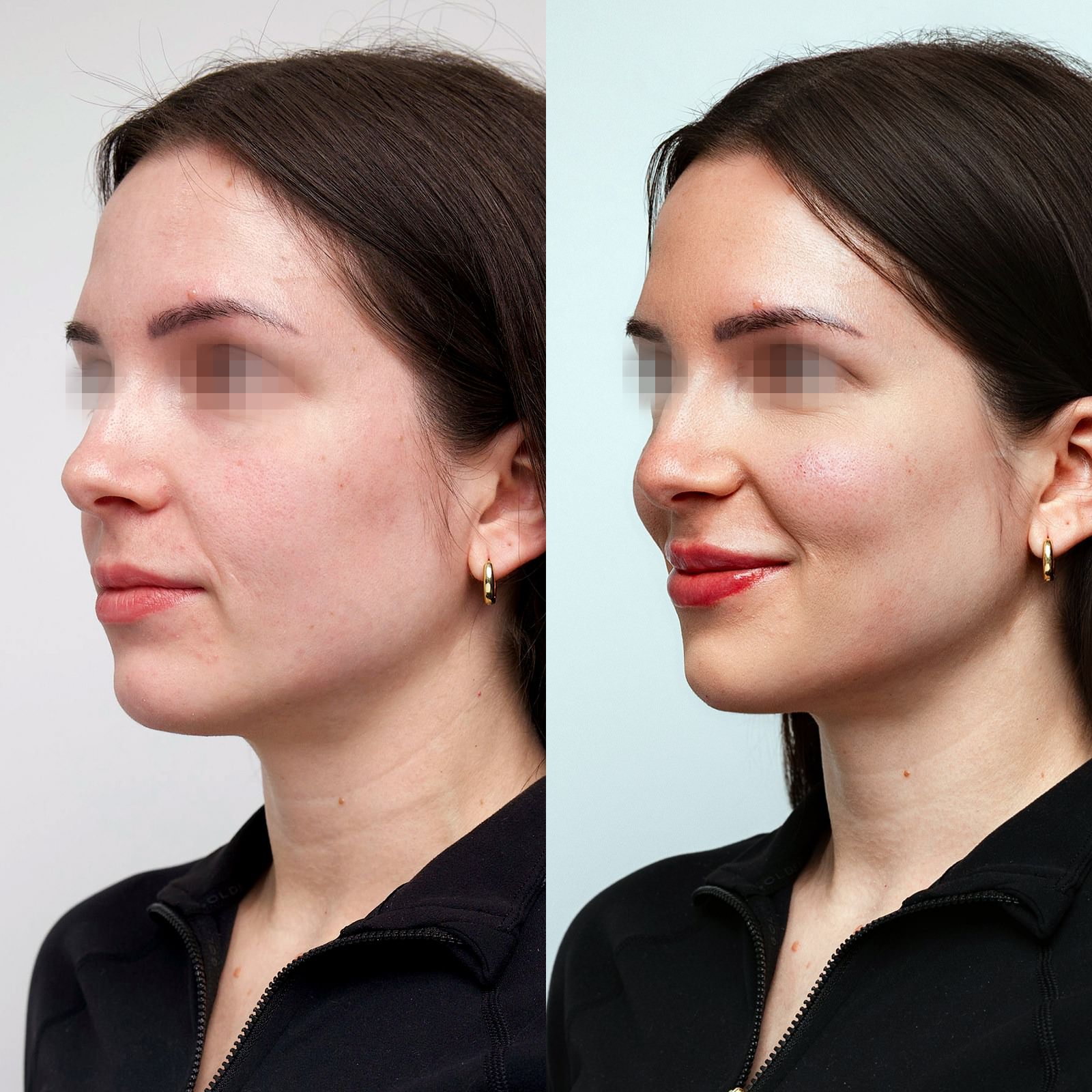 Rajeunissement complet du visage